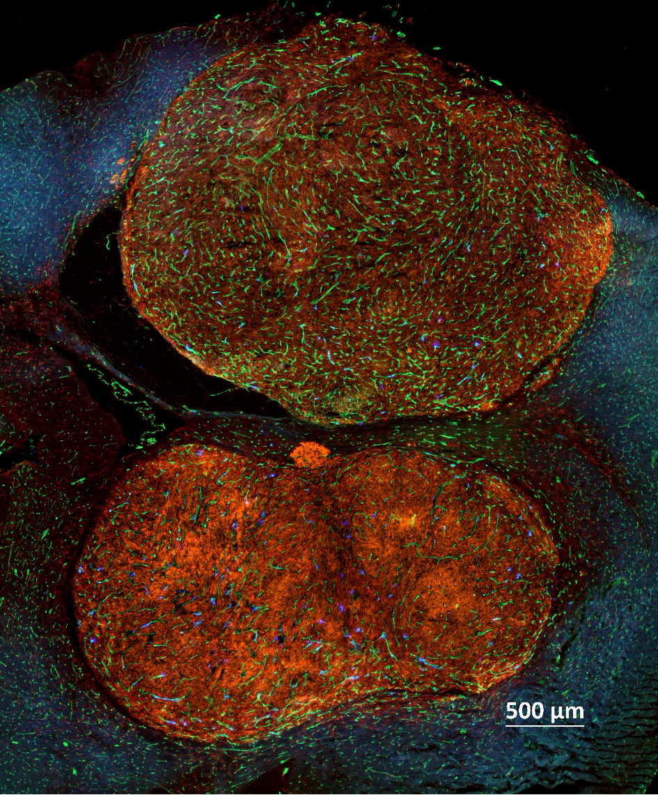Human tumor